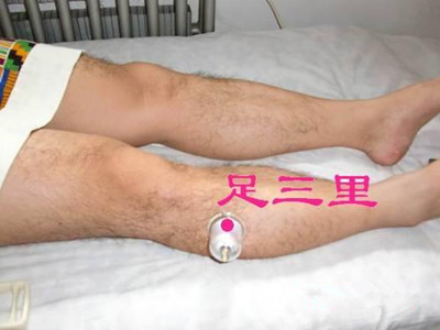 足三里拔罐的功效 排除體內毒素