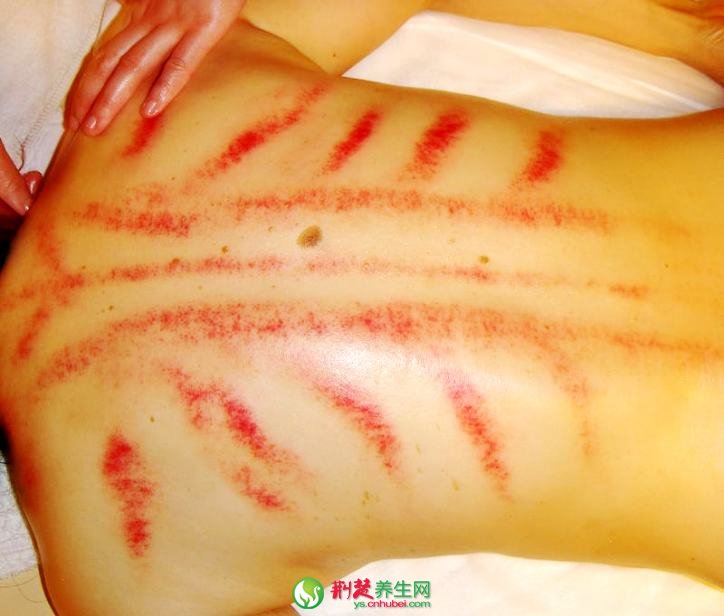 養生常識 為什么有人刮不出痧